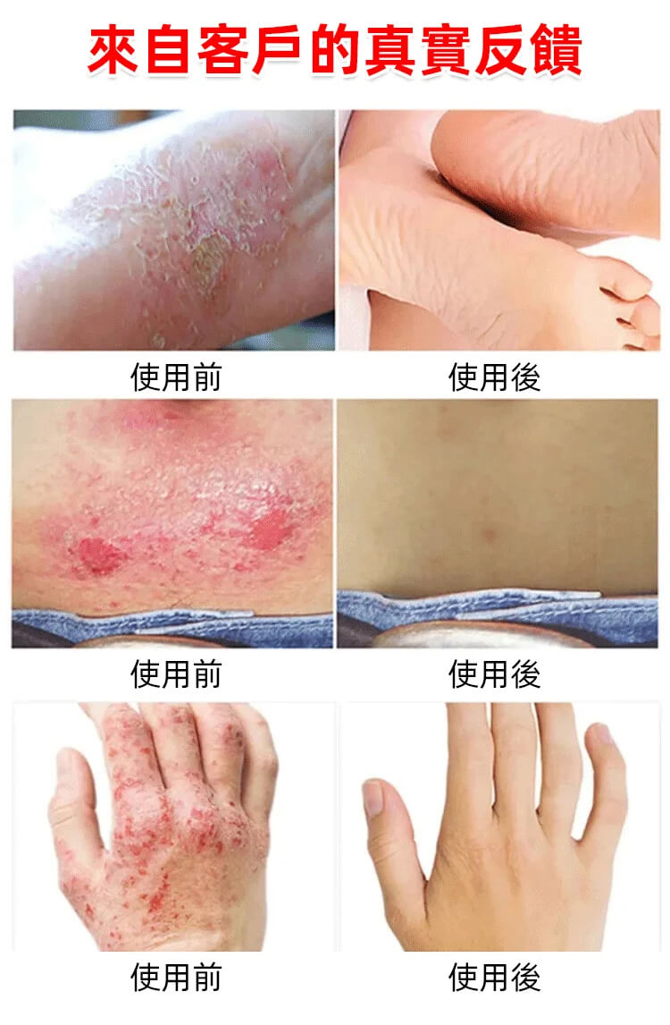 曼秀雷敦ad止癢消炎乳膏1780999783777353.jpg 曼秀雷敦ad止癢消炎乳膏